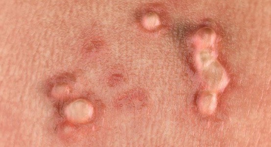 φωτογραφία για hpv hpv φωτογραφία